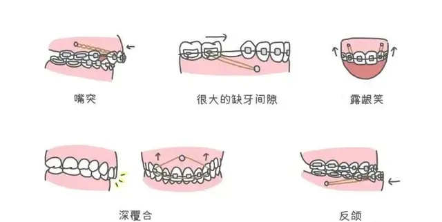 牙齿矫正的“利器”——支抗钉（骨钉）