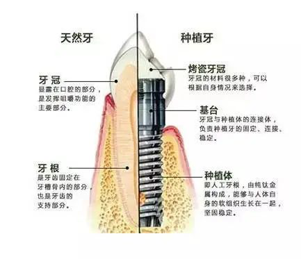 为什么牙医都推荐种植牙，可以用一辈子吗？来看看专家怎么说