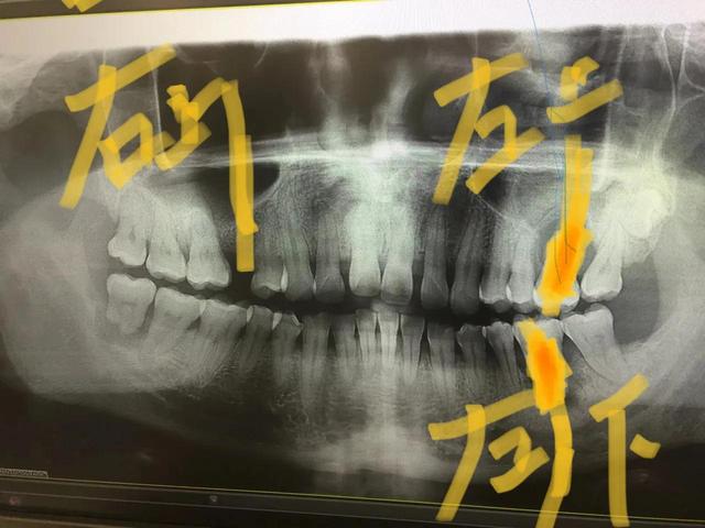 种植牙的经过