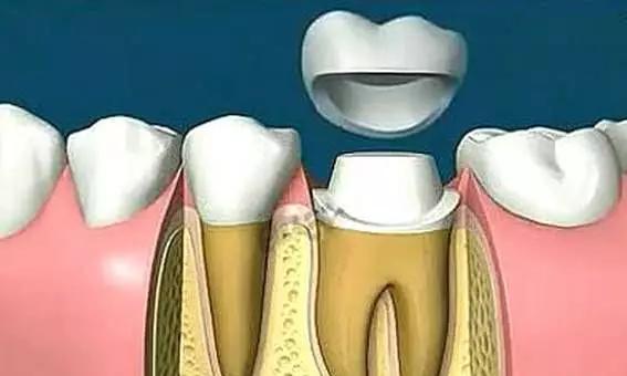 根管治疗后不做冠，治疗效果少一半