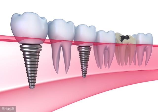 烤瓷牙pk种植牙，为什么种植牙这么贵？到底贵在哪里？