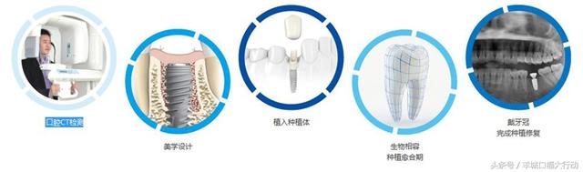 种植牙技术，您人生中的“第三副牙齿”