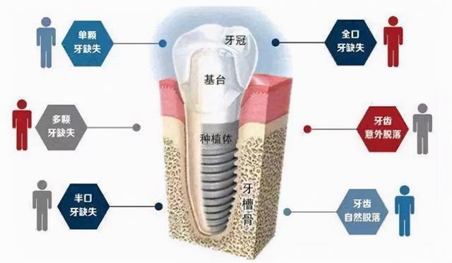 良心医生不建议种植牙？你觉得呢？