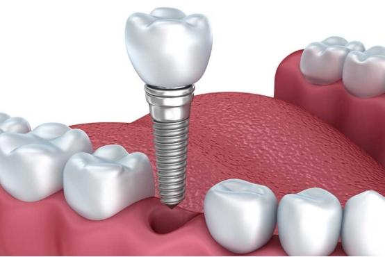 为什么牙医都推荐种植牙，可以用一辈子吗？来看看专家怎么说