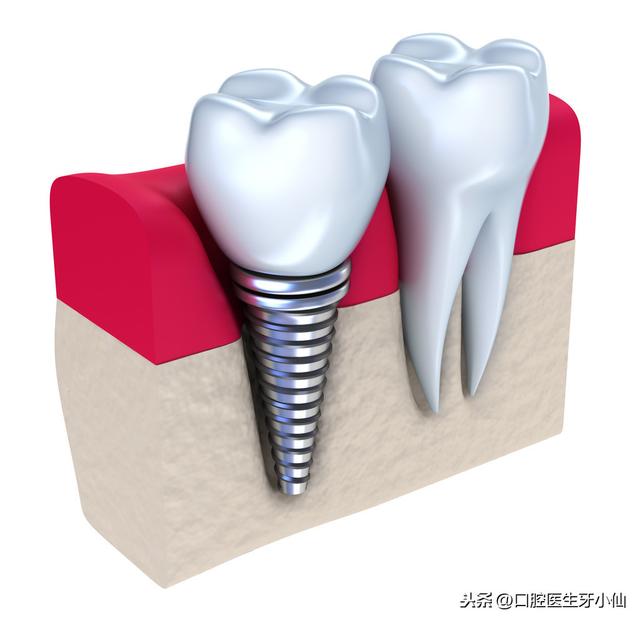 牙医告诉你，种植牙好，好在哪？