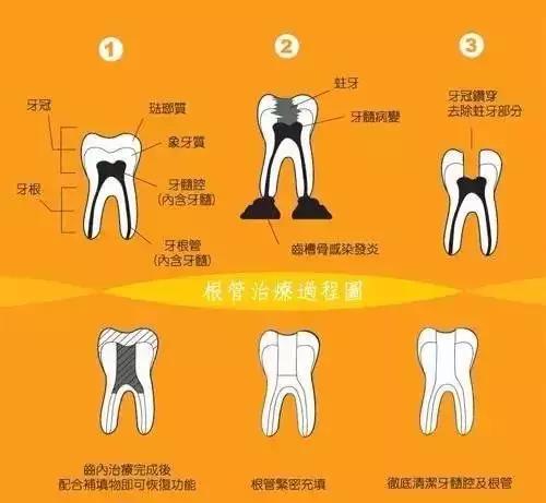 根管治疗后不做冠，治疗效果少一半