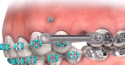 正畸打骨钉，不同位置作用大不相同！小心整牙不成反而更歪