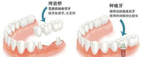 烤瓷牙和种植牙哪个好？关键看这3点