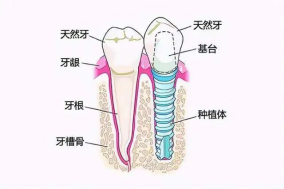 种植牙有那么可怕吗？就拧螺丝钉？一切等你了解后再说