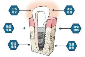 种植牙有那么可怕吗？就拧螺丝钉？一切等你了解后再说