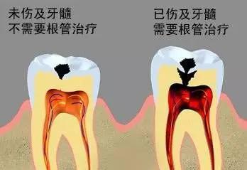 根管治疗后不做冠，治疗效果少一半