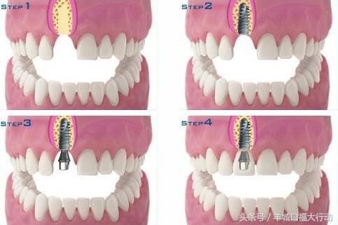 种植牙技术，您人生中的“第三副牙齿”