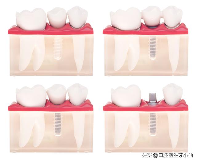 牙医告诉你，种植牙好，好在哪？