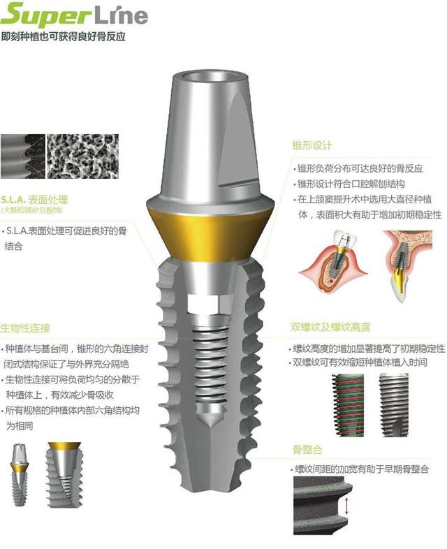 同是种植牙，为什么登腾种植牙那么便宜？因为它种植效果不好吗？