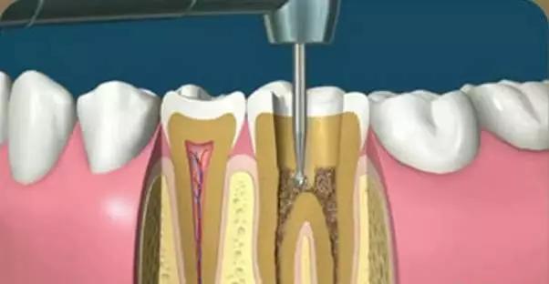 根管治疗后不做冠，治疗效果少一半