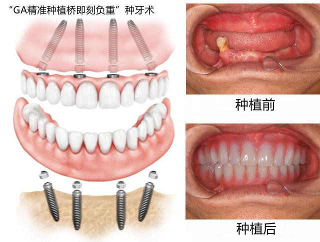 牙齿差不多掉光了，是镶牙好还是种植牙好？#良心牙医这样回答