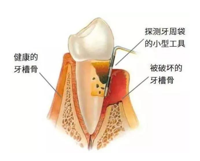 种完牙后应该怎样吃东西？这样做，让你“当天种牙，当天能吃”！