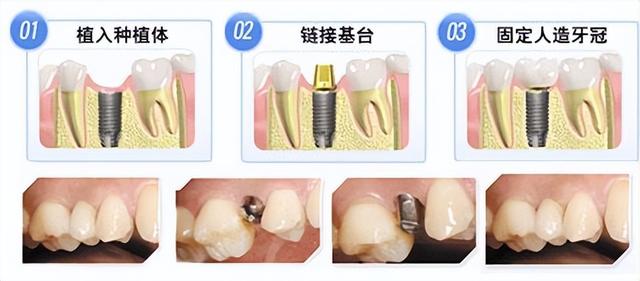 种牙哪个环节最难受？缺牙人群必看