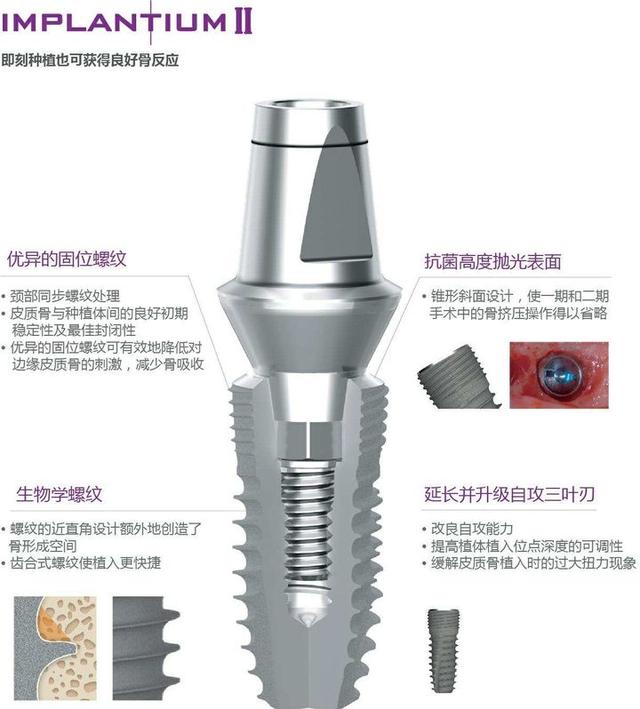 同是种植牙，为什么登腾种植牙那么便宜？因为它种植效果不好吗？