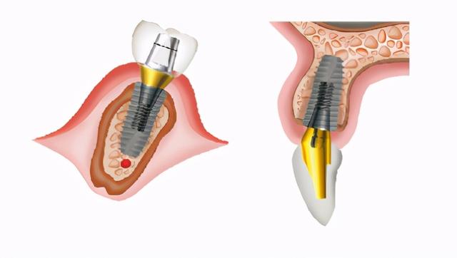 同是种植牙，为什么登腾种植牙那么便宜？因为它种植效果不好吗？