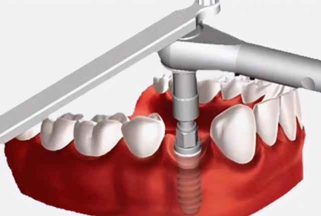 口腔卫生不佳，会发生种植体周围炎？真相了