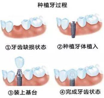 种植牙到底是怎么“种”的？