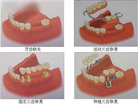 牙齿差不多掉光了，是镶牙好还是种植牙好？#良心牙医这样回答