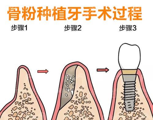 听说种牙必须先植骨？牙槽骨低于这个数值，可能确实要植骨！