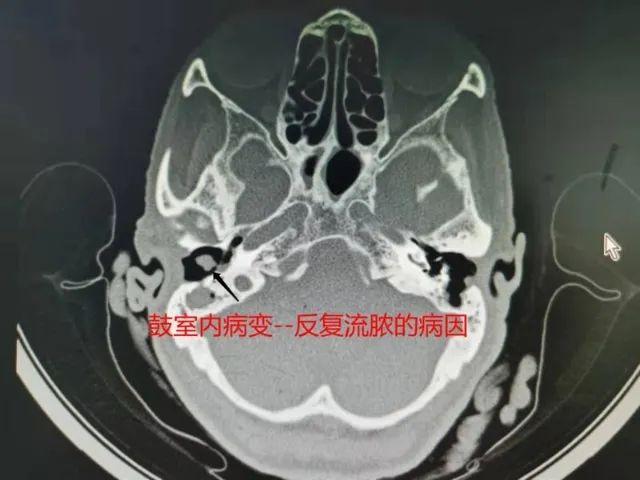 吓一跳！大理80岁老奶奶耳朵里取出20条活蛆......