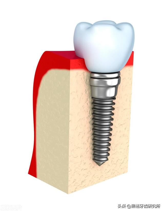 六旬老人去种牙，手术后就后悔！良心牙医：不是什么人都能种牙