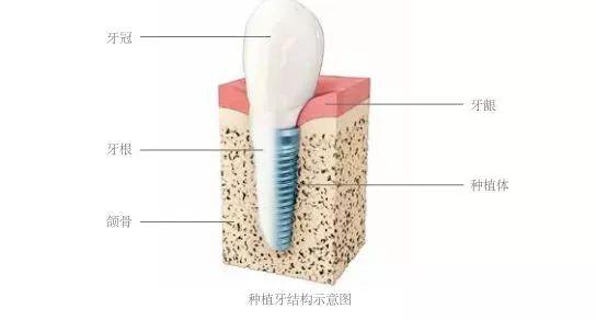 给8岁儿童种牙，这个案例为何被称为口腔界的耻辱？