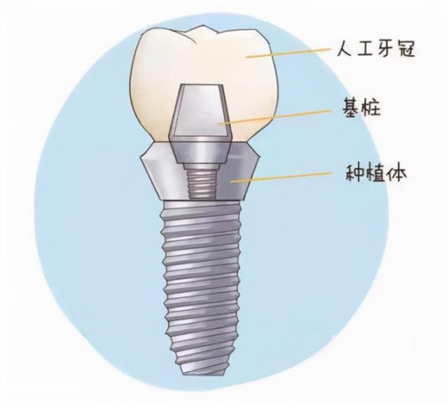 「牙齿那些事儿」No.67丨牙齿也能“种”出来？这有份种植牙攻略