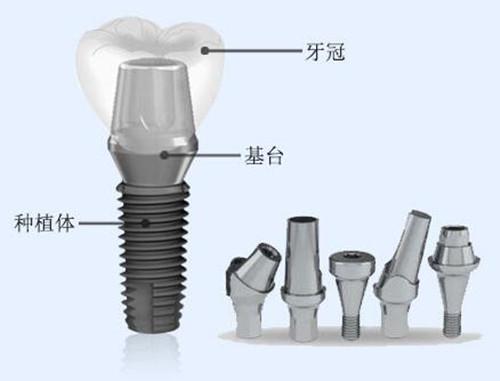 大连齿医生科普 比较3类种植牙哪类技术好