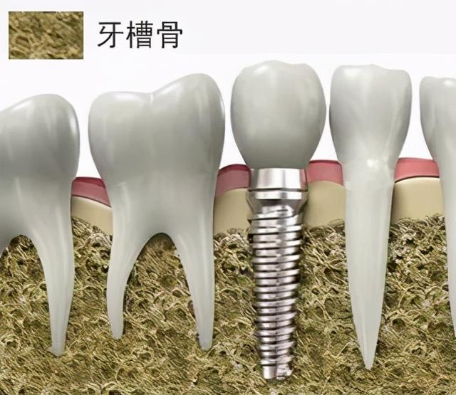 准备做种植牙，会经历些什么？#雅悦齿科#