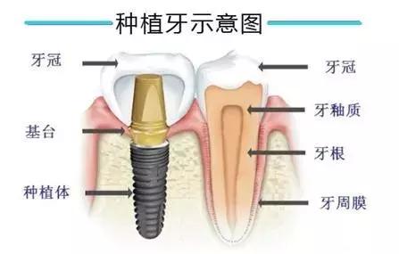 种植牙 VS 镶牙，哪个更胜一筹？