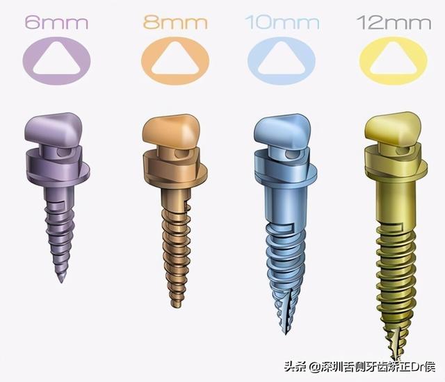 牙齿矫正神器：骨钉