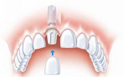 带您了解种植牙