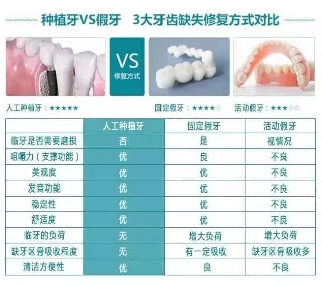 种植牙 VS 镶牙，哪个更胜一筹？