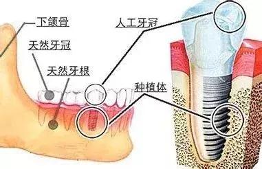 种植牙 VS 镶牙，哪个更胜一筹？