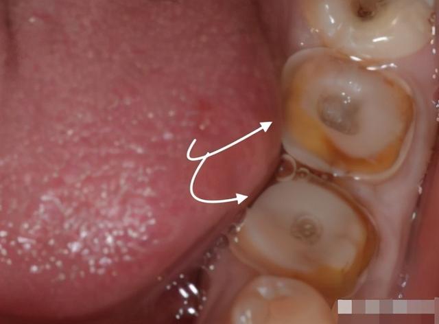 戴得好好的牙冠突然脱落，跟这5种原因脱不了干系