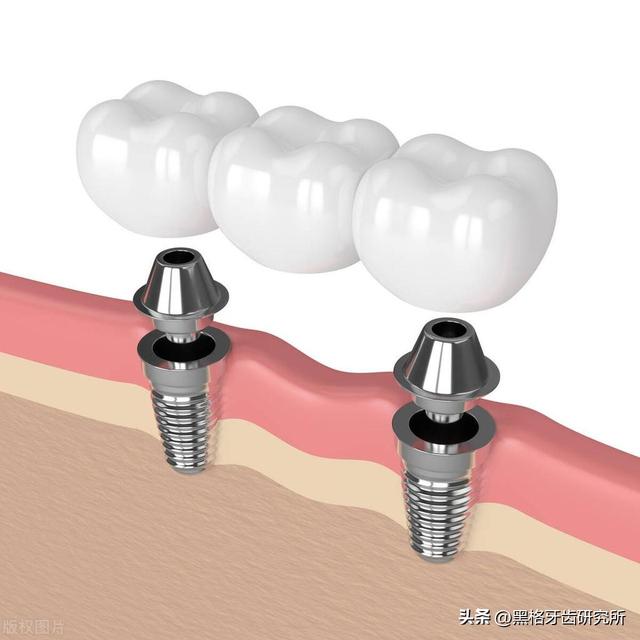 镶牙不行？缺牙去种牙是最好的？不一定！良心牙医手把手教你选