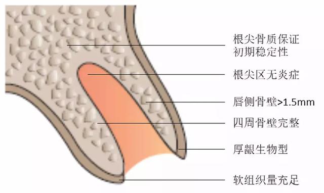 拔牙后要等3个月才能种新牙？即刻种牙技术了解一下