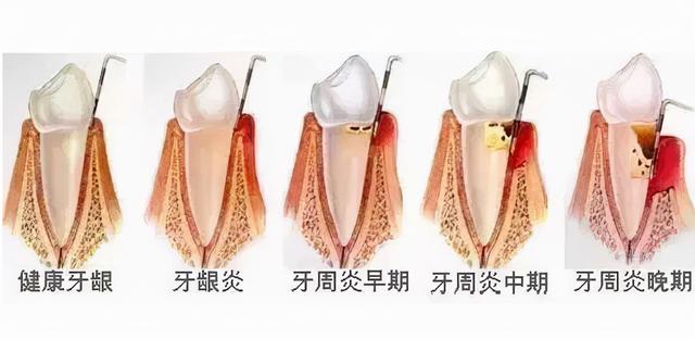 牙周病患者做种植牙失败率很高，种牙前要注意这方面