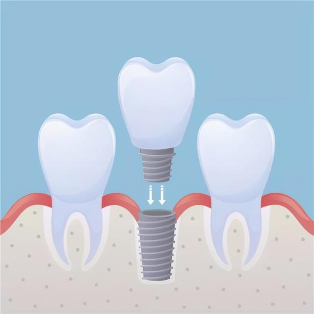 「牙齿那些事儿」No.78丨同样是种植牙，为什么使用寿命大不相同