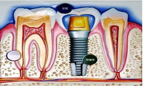 国内种植牙技术目前成熟吗？