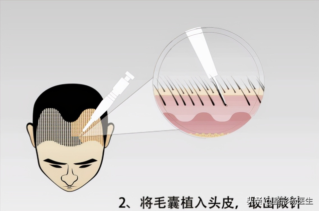 科普：微针植发到底靠谱吗？有哪些优势？