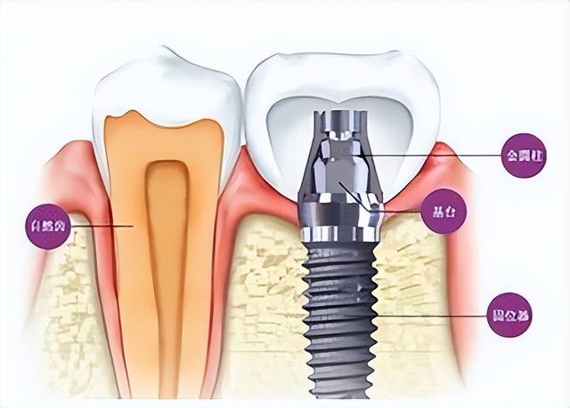 口腔种植需要了解的那些事