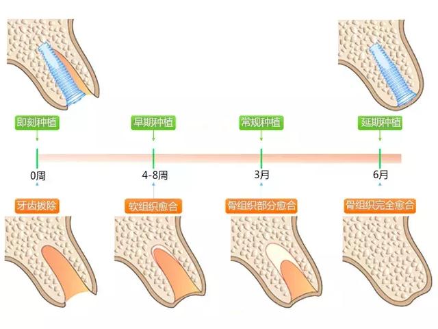 拔牙后要等3个月才能种新牙？即刻种牙技术了解一下