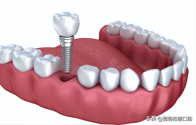 「牙齿那些事儿」No.167丨种植牙掉了还能再种吗？