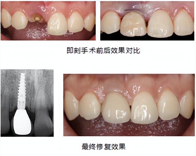 门牙磕断了？微创即刻种植，简直太哇塞了！